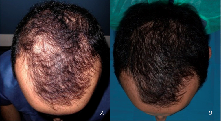 Hair Loss Treatment Hair Transplant Or Microneedling With Prp